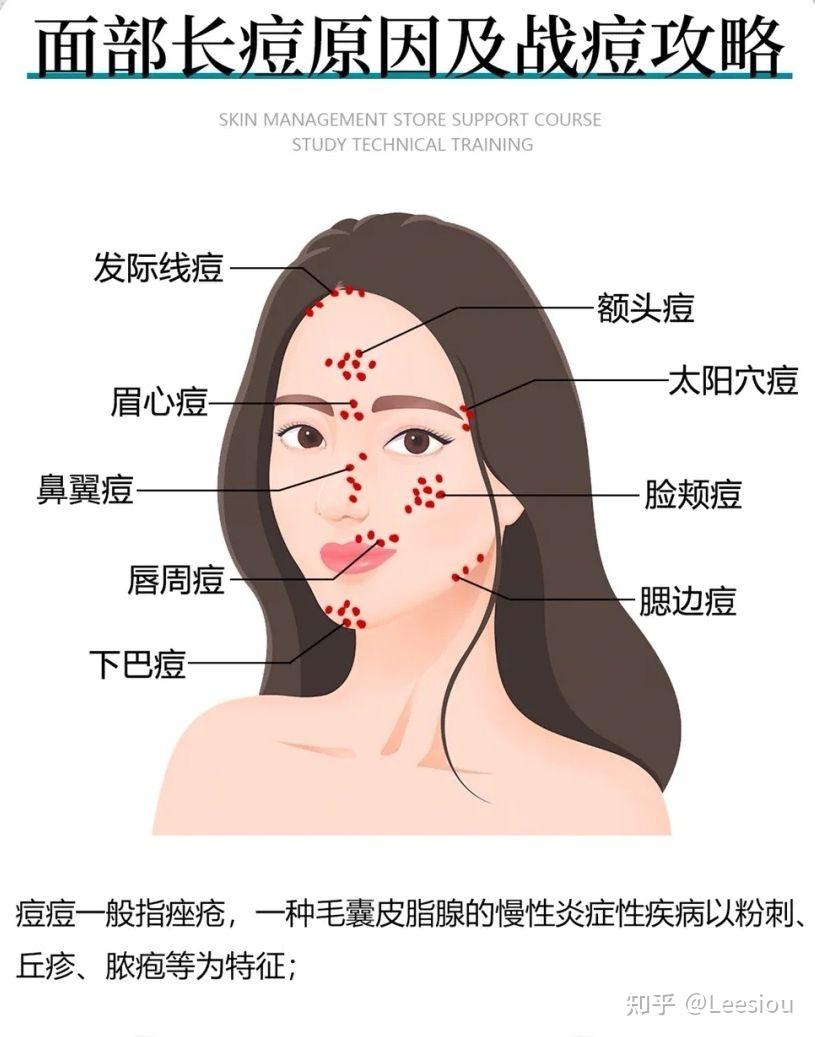长痘怎么治疗？额头闭口多? - 知乎