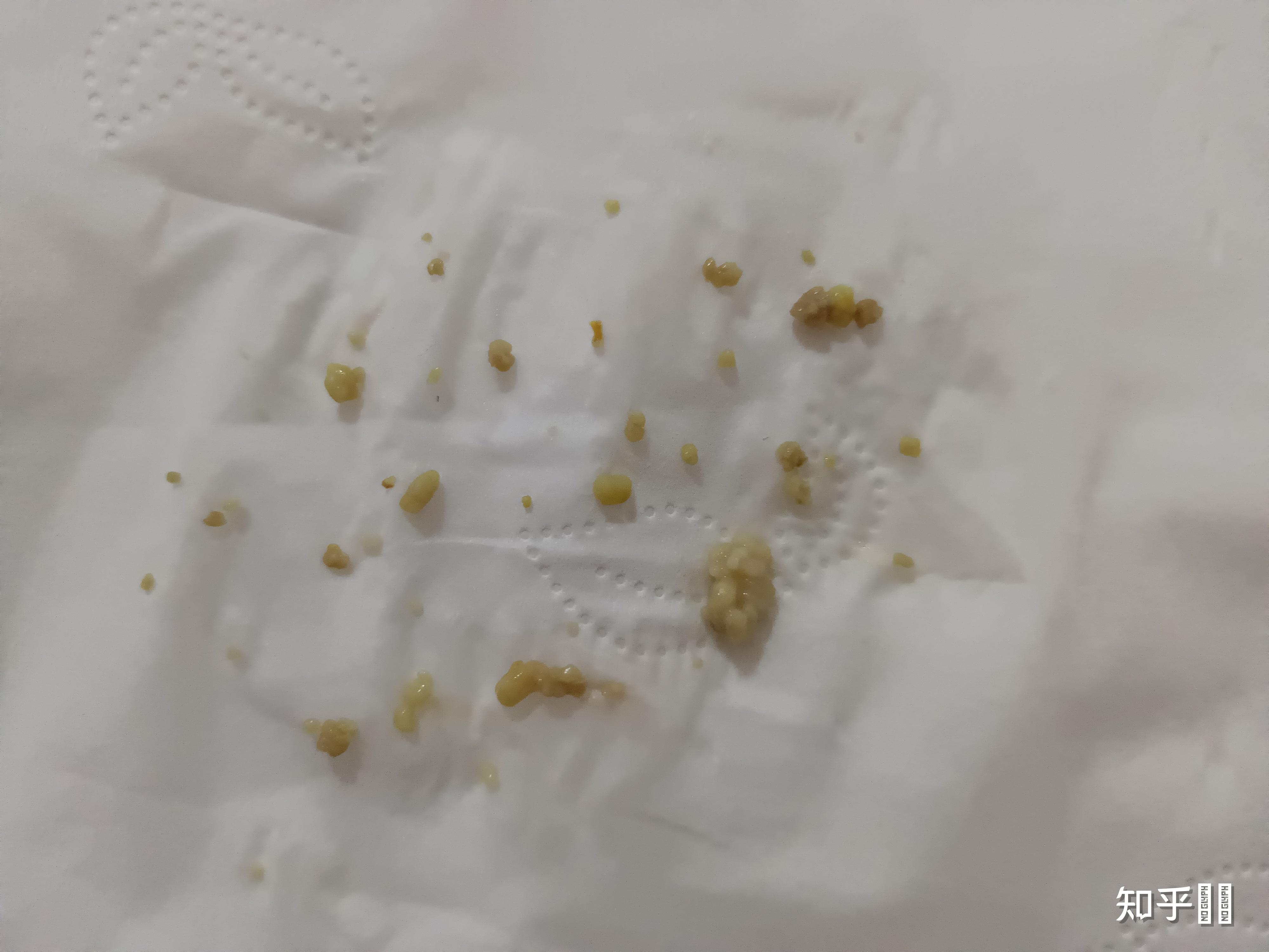 扁桃体结石能大到什么程度