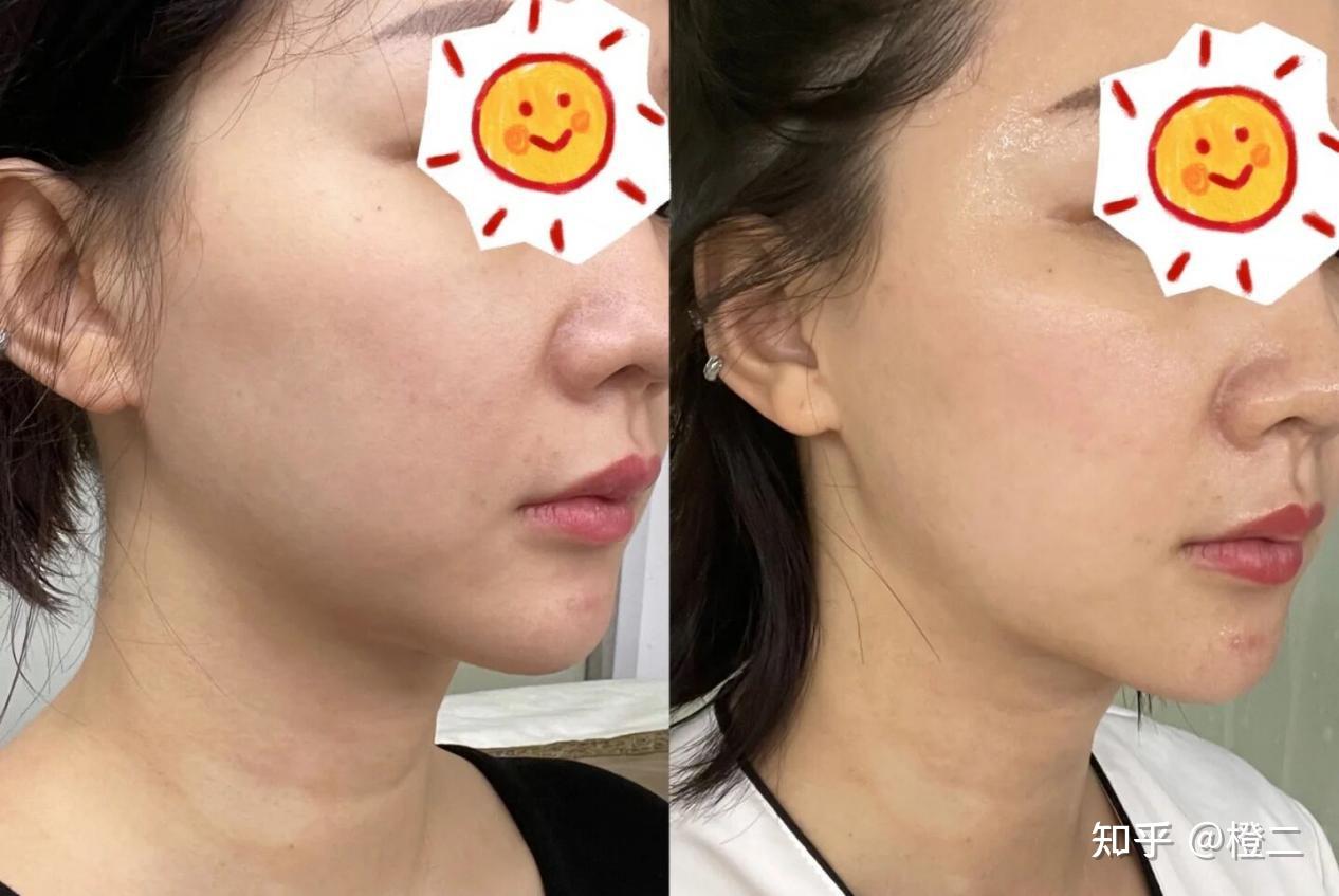 脸变大发腮怎么解决?不同类型的发腮解决攻略请你收好(附发腮测试)