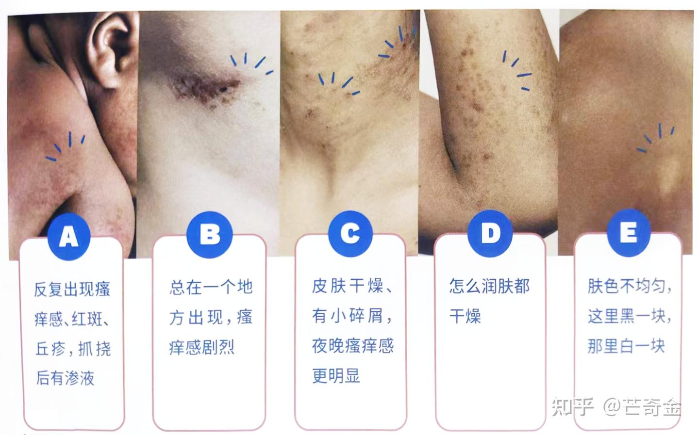 实用!宝宝常见“疹疹”问题对照分辨护理 - 知乎