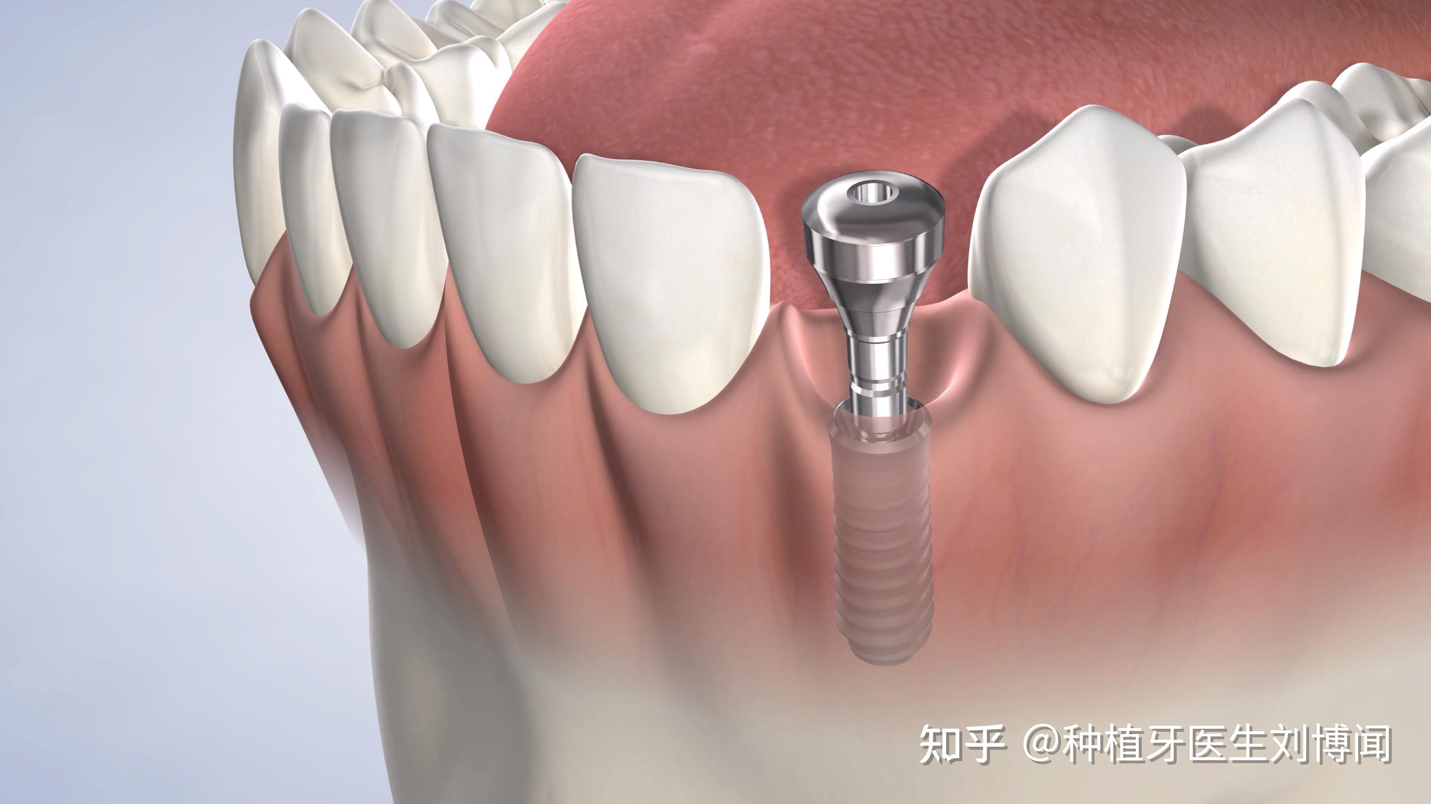 种植一颗牙多少钱呀