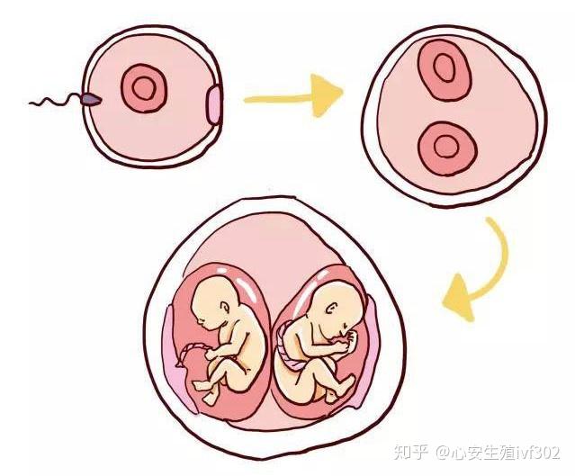 试管婴儿怎么怀得上龙凤胎?怀龙凤胎的秘诀公开! - 知乎