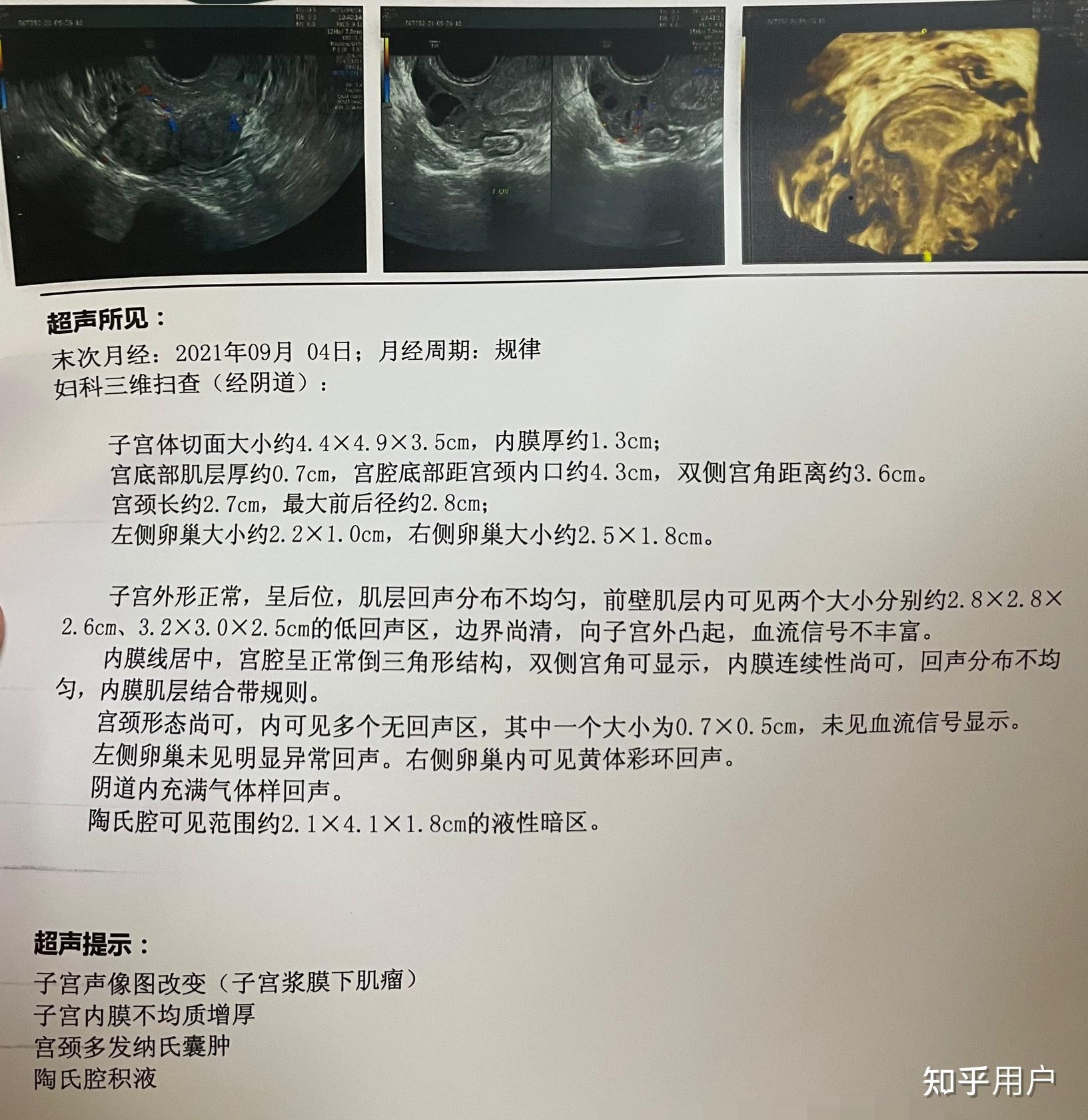 子宫多发肌瘤肌层浆膜下是什么意思