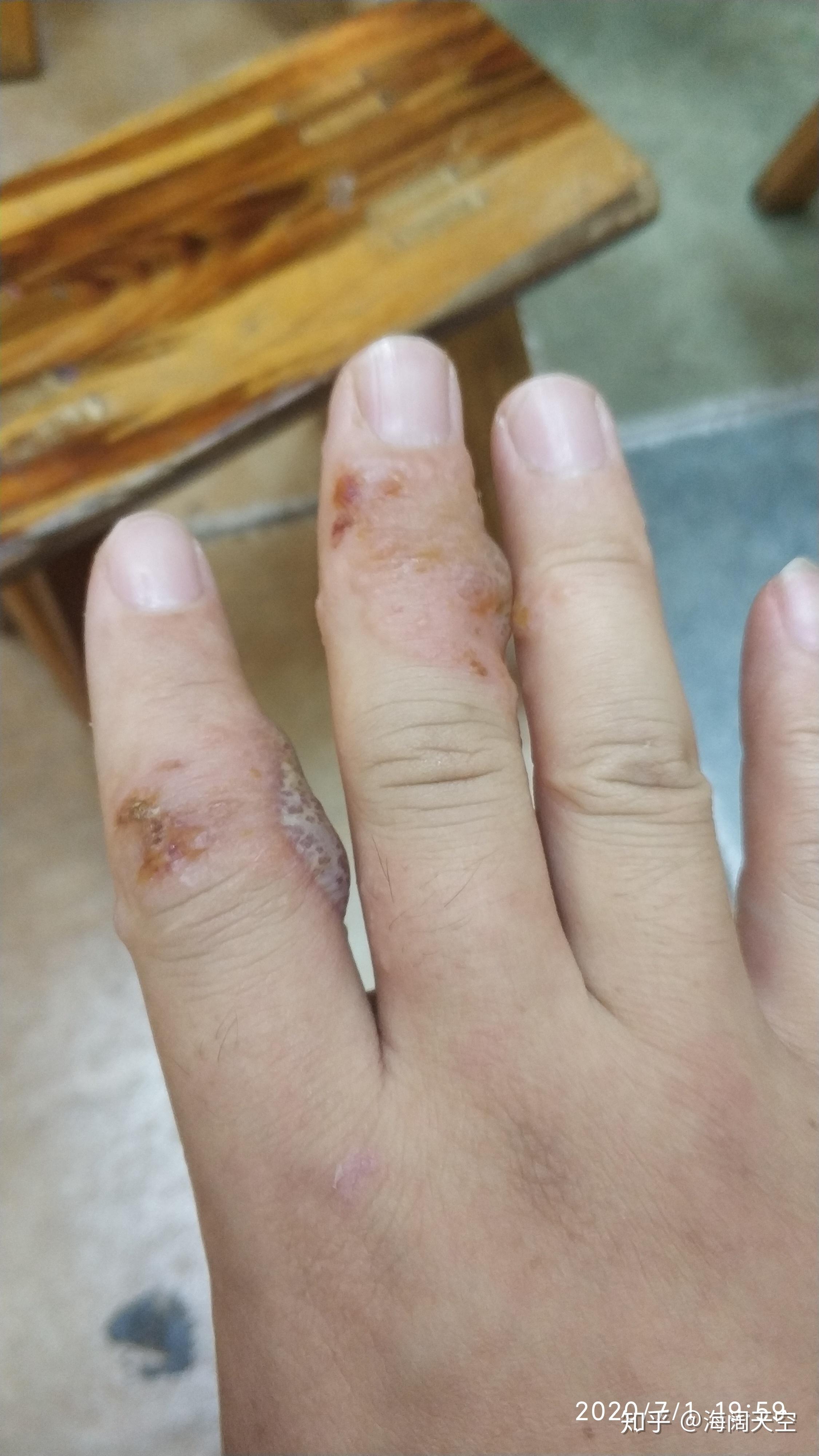 手指受伤贴了创口贴几个小时后贴创口贴的部位开始起水泡特别痒是过敏