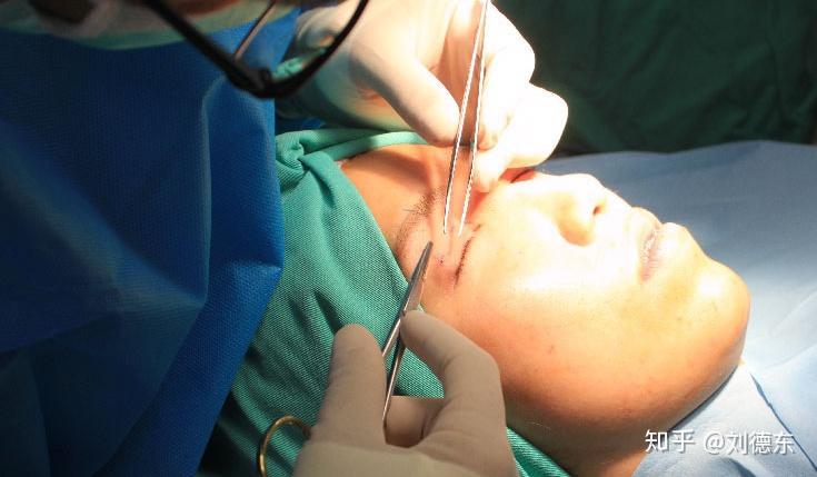 割完双眼皮两边不一样怎么办