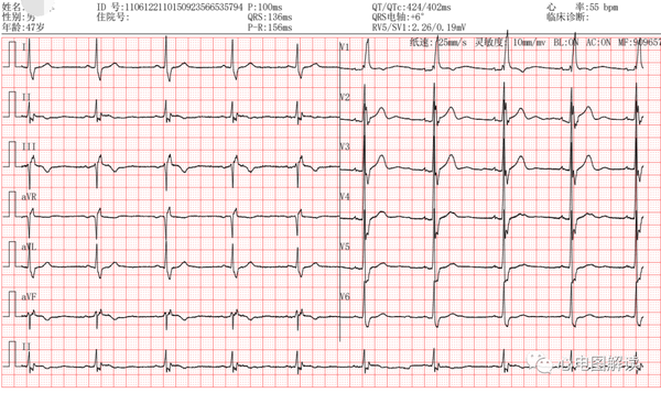 完全性右束支阻滞在12导联及右胸导联的表现,右心室大?