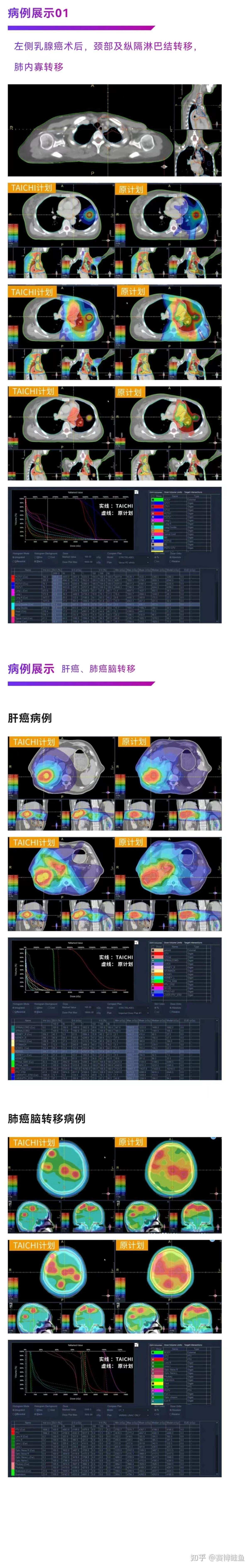 放射组学和影像组学，放射组学和影像组学的关系