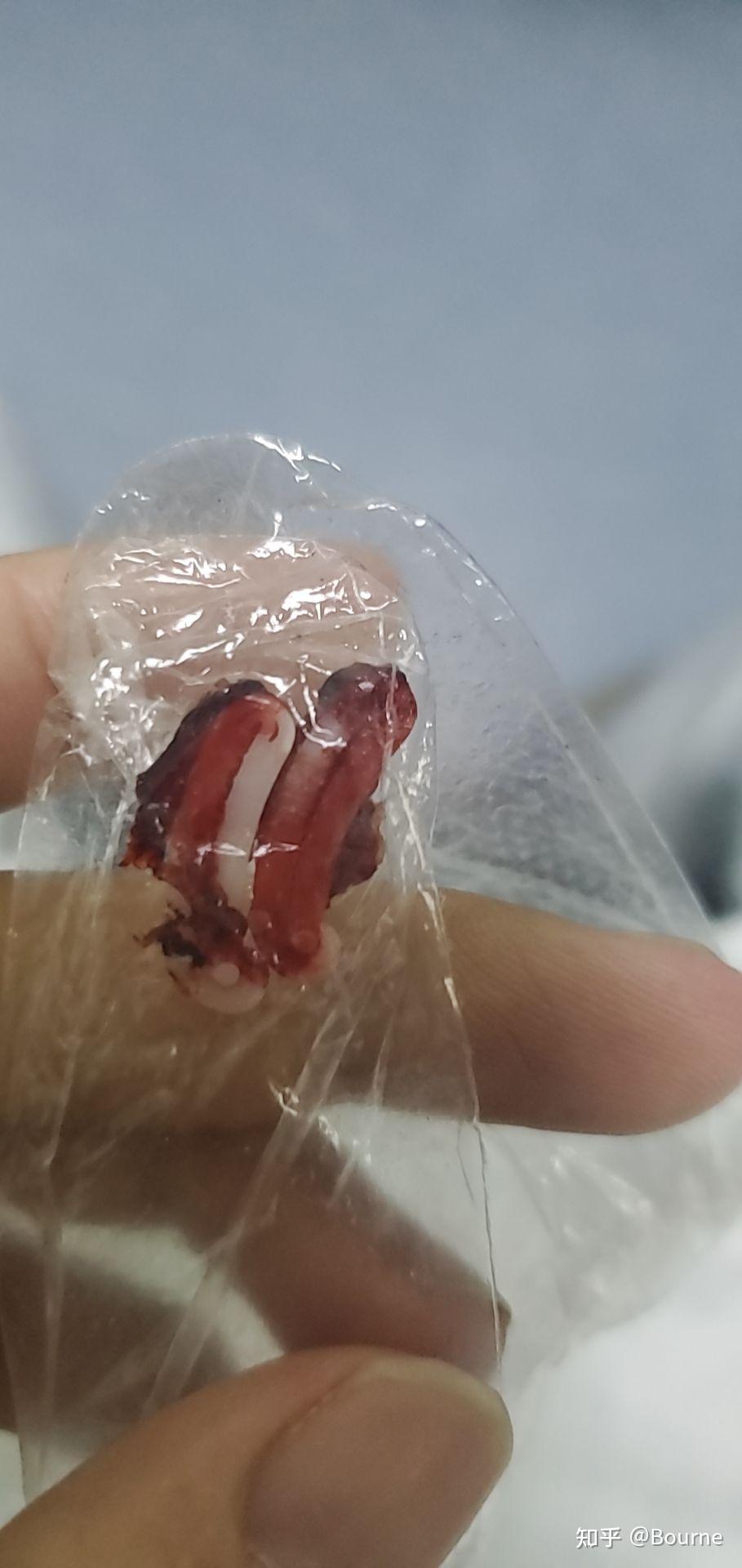 阑尾炎手术后遗症的9个月14天