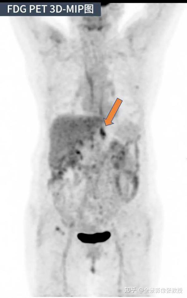 案例分享：PET/CT检查优势——快速寻找原发灶&准确确定病灶性质！ - 知乎