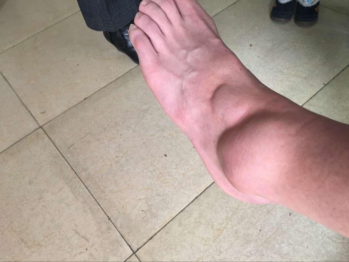 你打篮球遇到过的最严重伤病是什么打篮球真有那么容易受伤