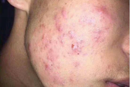 男生脸上爱出油,长痘痘用什么护肤品比较好?
