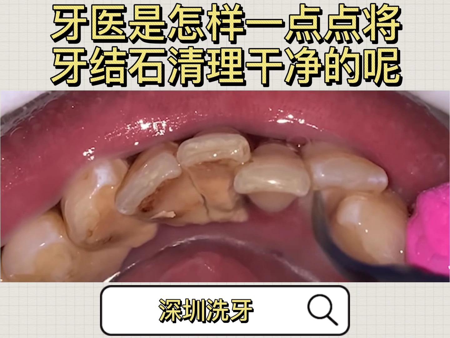 洗牙 重度牙结石