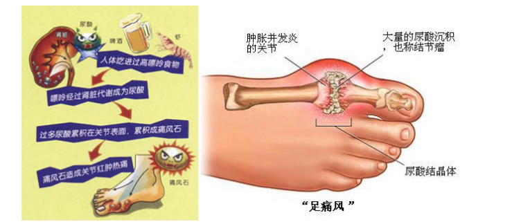 第二阶段为: 为痛风早期,血尿酸持续性增高,导致急性痛风性关节炎突然