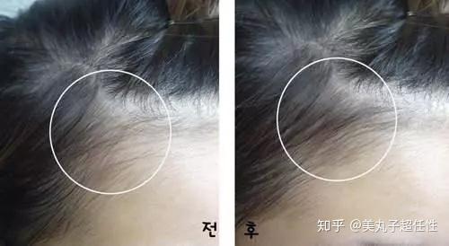 怎样的发际线才算高,我这样的发际线算不算高? - 知乎