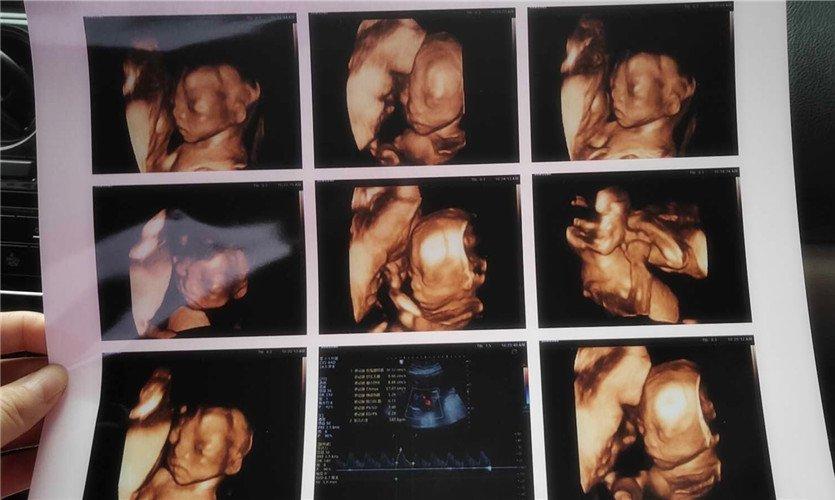 几个月做四维彩超花多少钱 v2-260fea2435eb7c8eea8f206d95221749_1440w.jpg?source=172ae18b