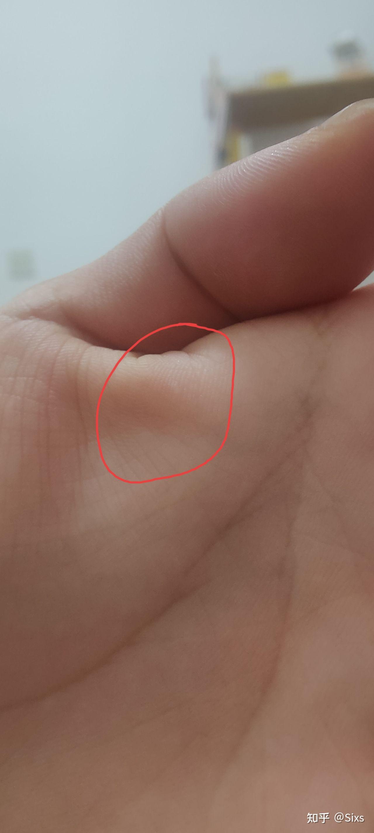 手掌上面长了一个透明的东西