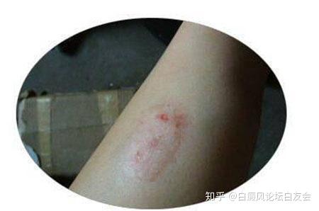 皮肤病 皮癣与牛皮癣到底有什么区别 知乎