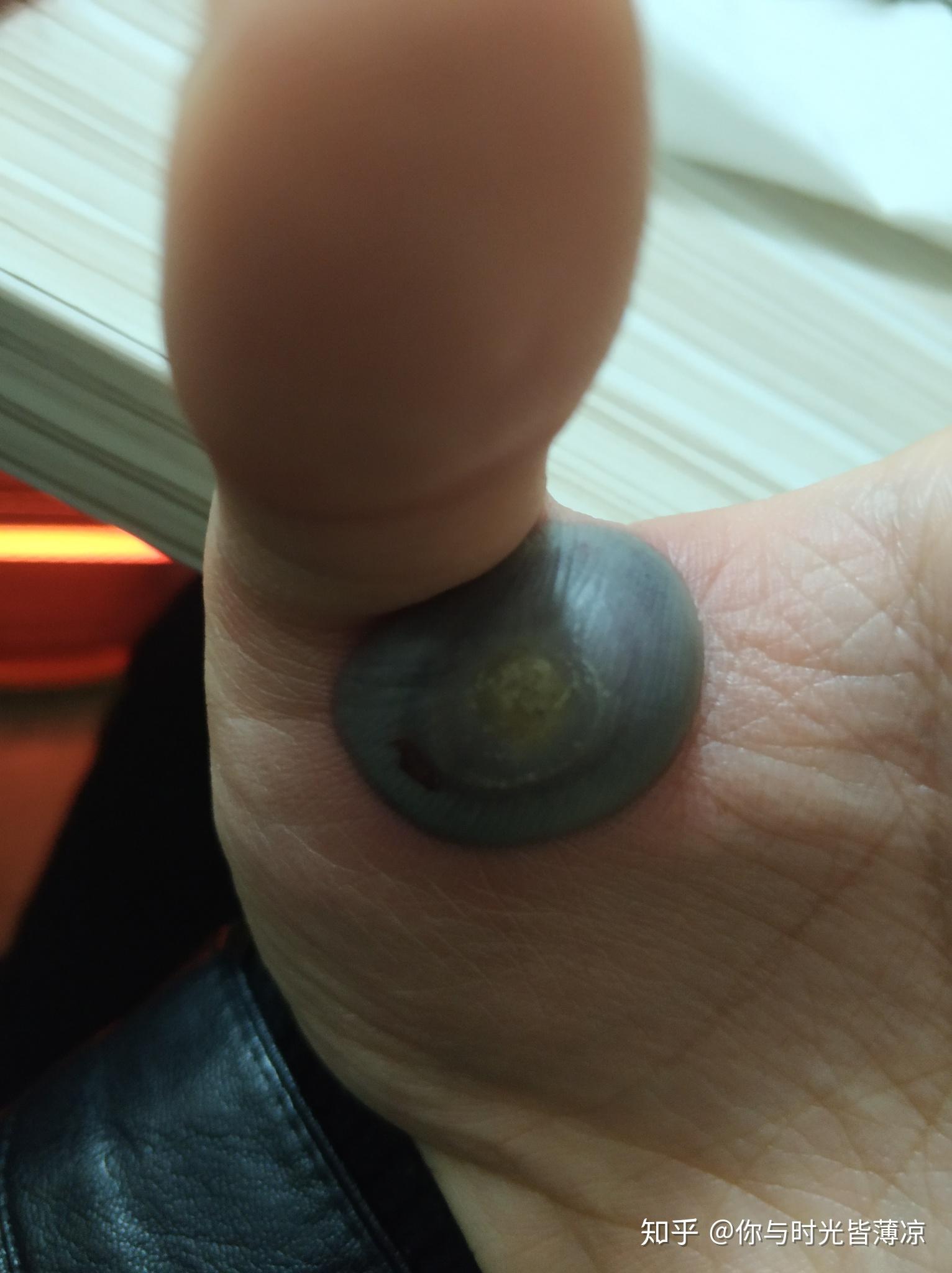 液氮冷冻治疗后手指上出了血泡而且越来越大该怎么办? - 知乎