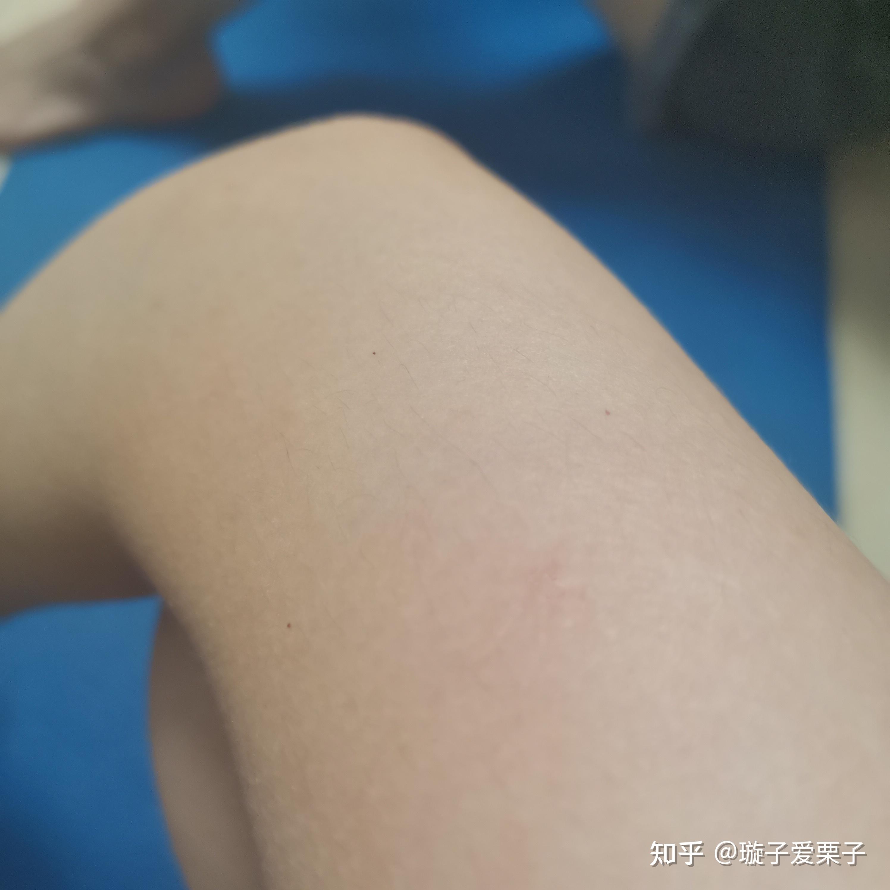 男19身上起了好多针孔大小的红点点请问这是什么痣