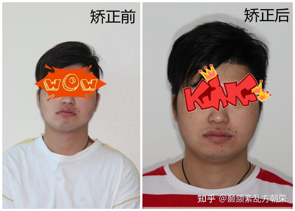 颞颌紊乱牙齿矫正治疗时我在思考什么