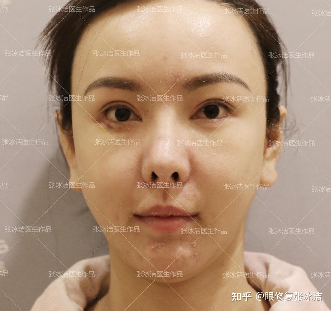 张冰洁下睑下至修复丨下至凹陷疤痕磨眼球修复四个月恢复记录