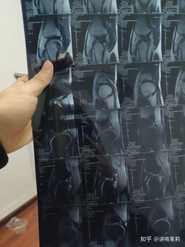 半月板后角变性怎么康复训练目前不能下蹲走路有点疼