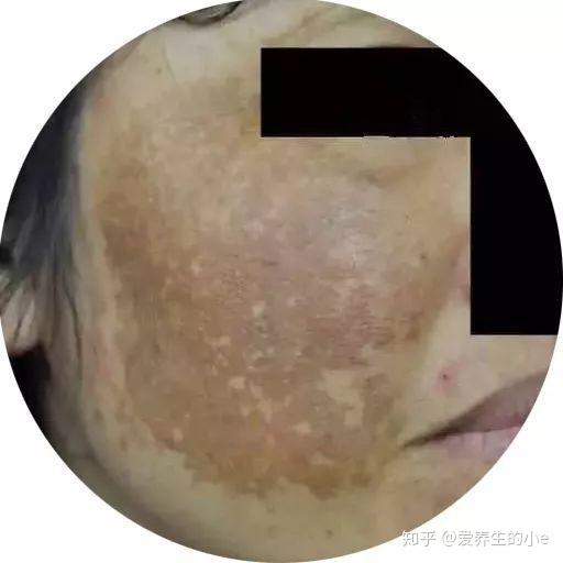 若血瘀严重的话,色斑一般为灰褐或者黑褐色,连接成片,并伴有月经色暗