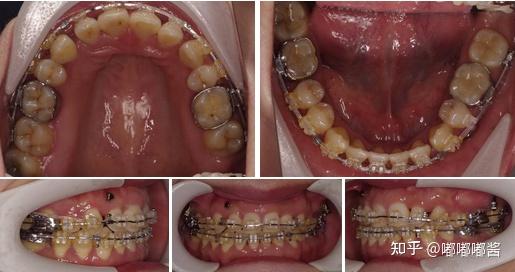 正畸案例分享丨高角前突露齦笑案例