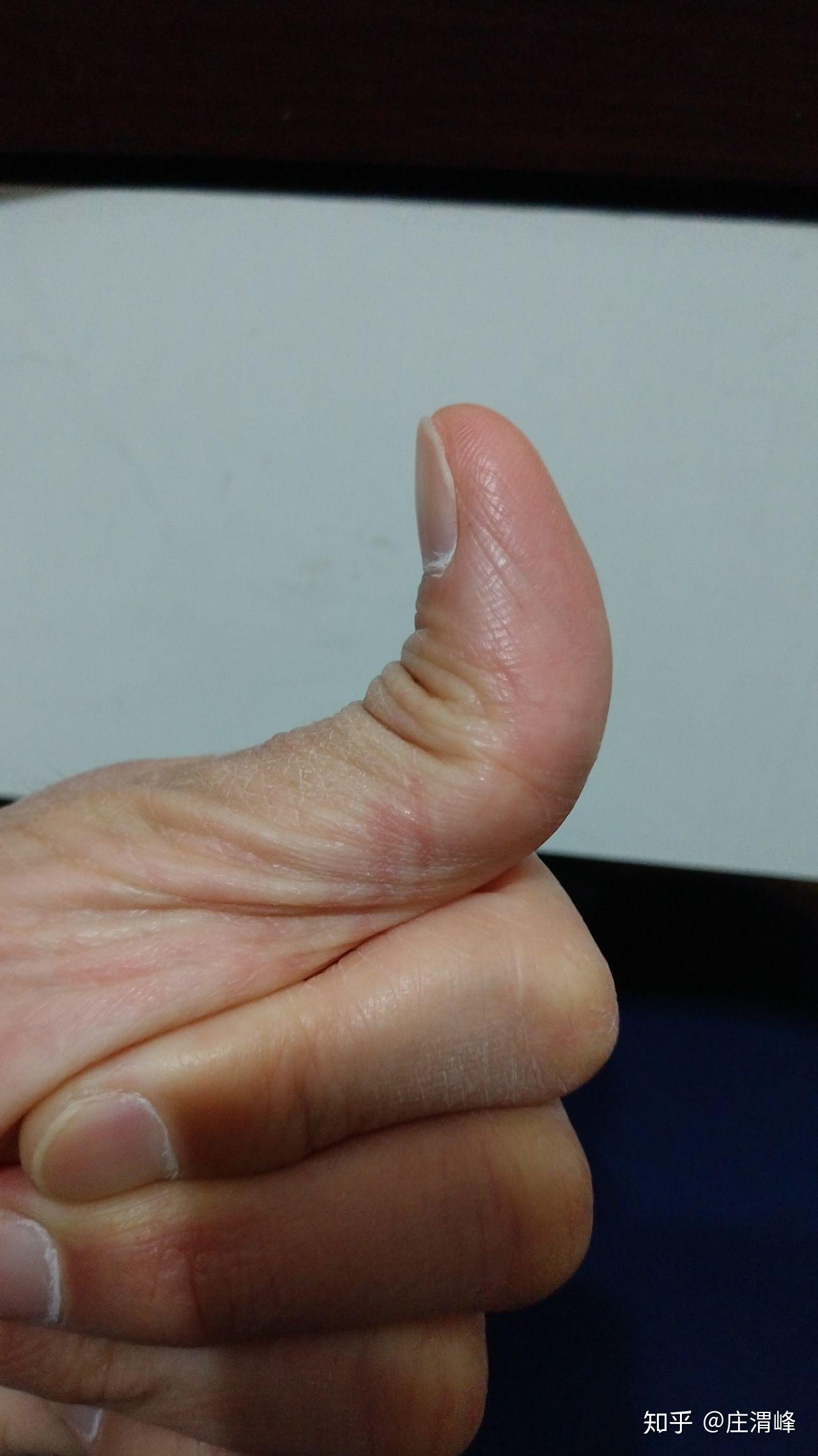 为什么有的人大拇指可以往后弯,而有的人不行? - 知乎