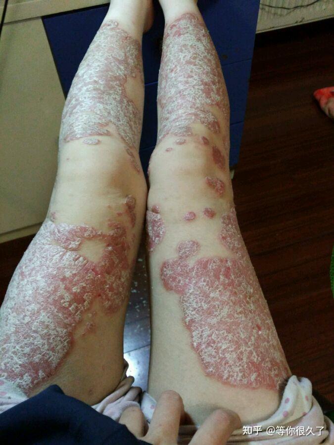 你见过最严重的牛皮癣是什么样子的? - 知乎