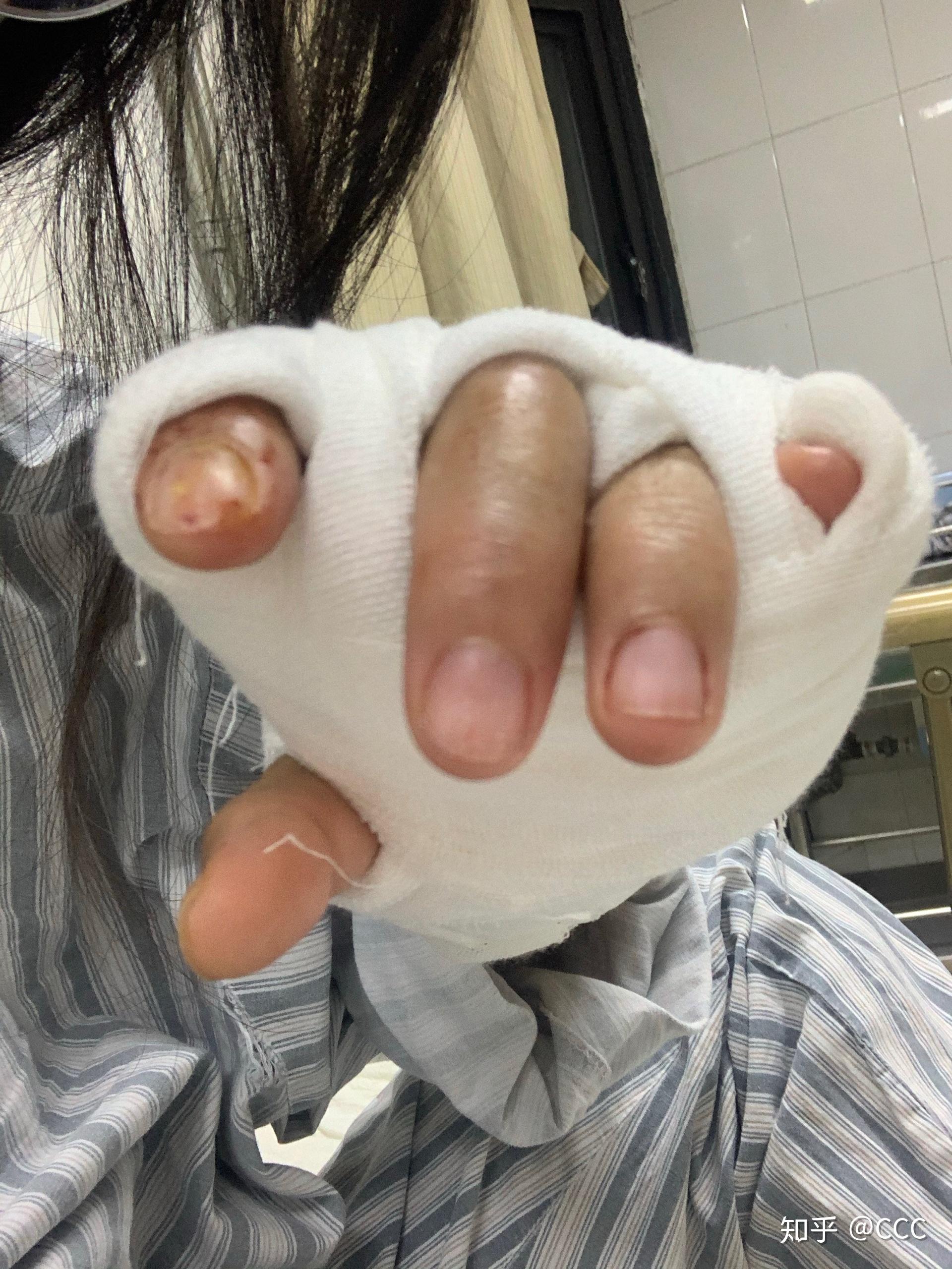 去瑞金医院做了手部烧伤整形手术做完手术没有美化反而更严重我该怎么