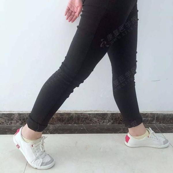 长短腿很多都是因为肌肉张力不平衡造成的骨盆侧倾引起的,或走路时