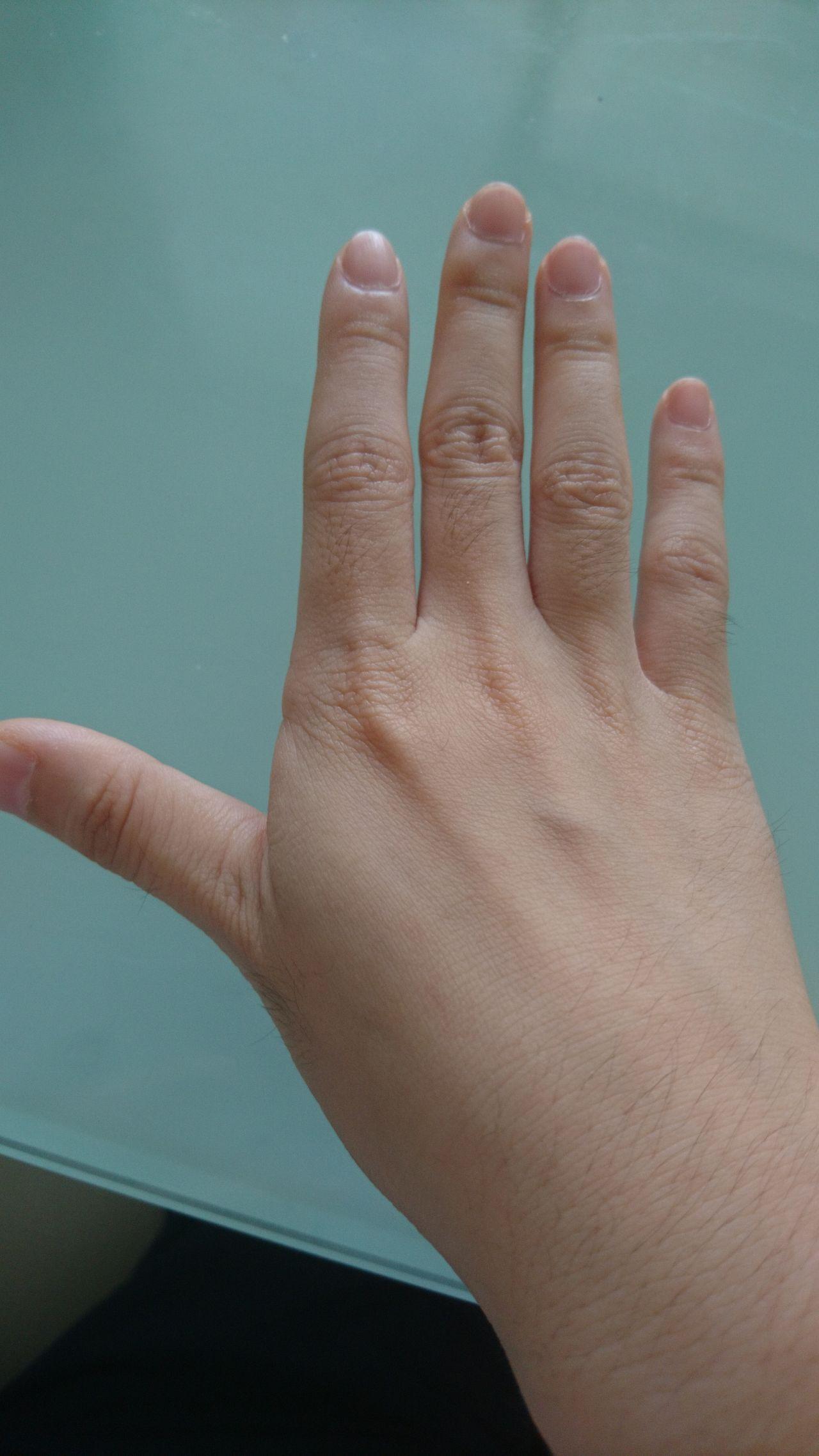 年纪轻轻23岁手上皮肤就很干有很多皱纹,像老年人干瘪的手,怎么办呀?