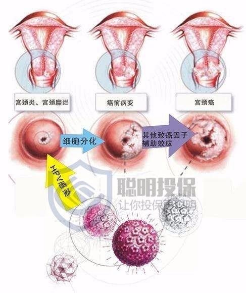 宫颈炎会变成宫颈癌吗图片