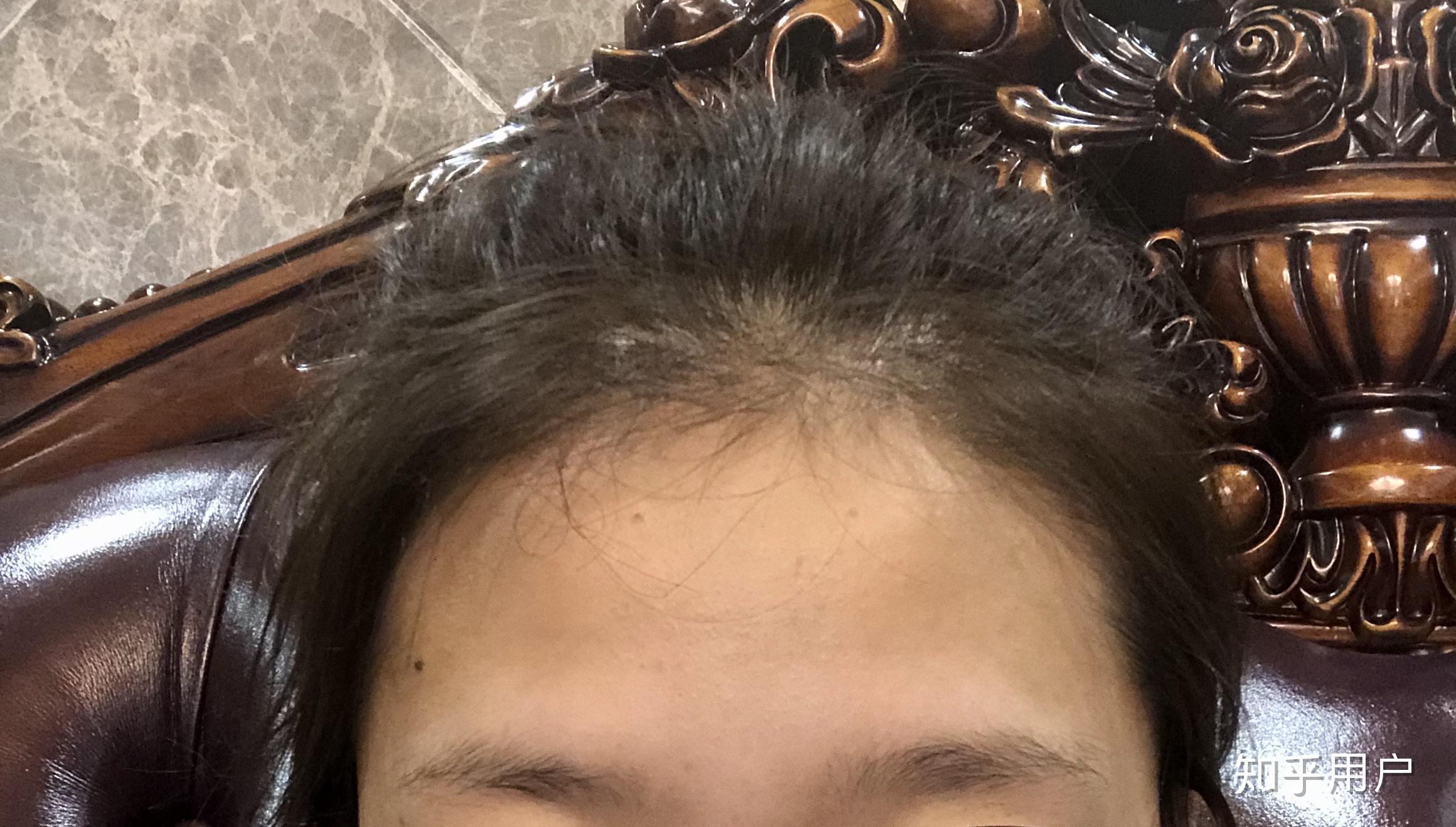 额头中间有凹陷 知乎