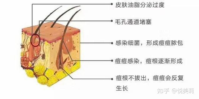 产品那么多，谁才是痘敏肌终结者？ - 知乎