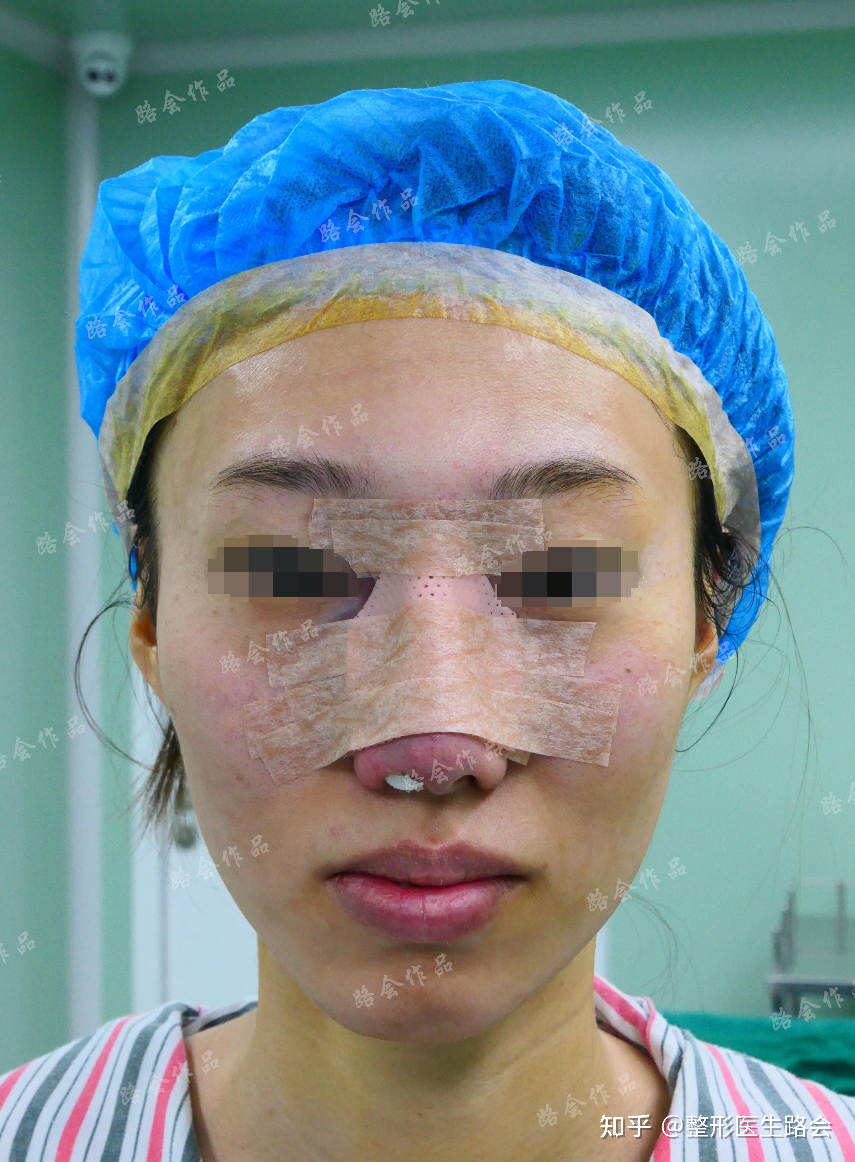 填充后鼻子严重变形?30岁河南姑娘用"非法注射物"让人心疼! - 知乎