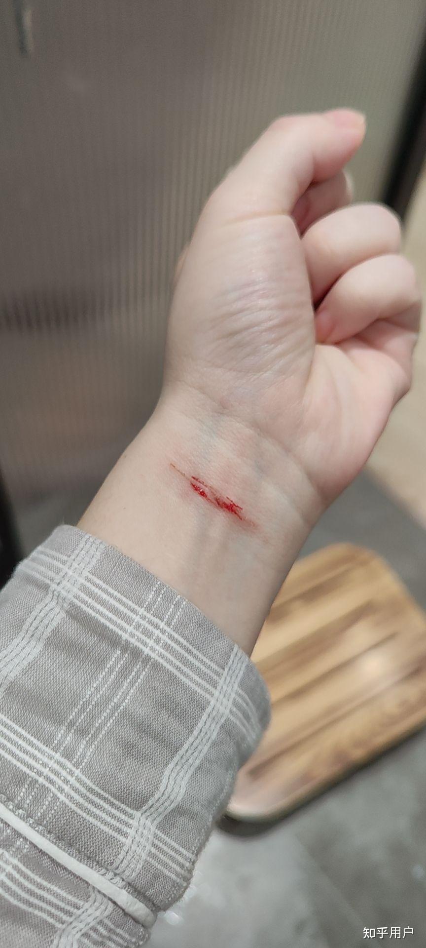 "割腕""自残"的"心理障碍患者"一般有怎样的心理动机?