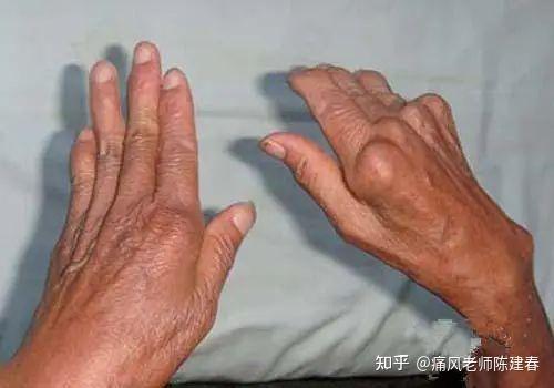 真假类风湿关节炎你能分得清吗?