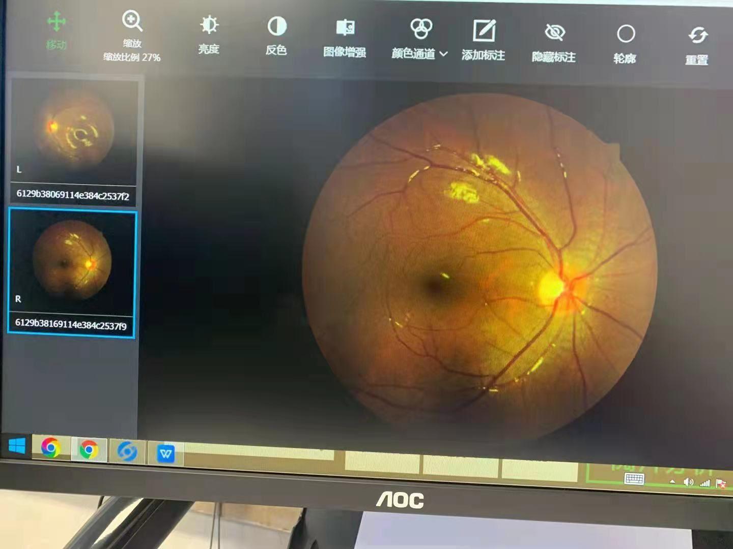 常见眼底疾病检查结果的秒懂解读_视网膜_彩照_天津