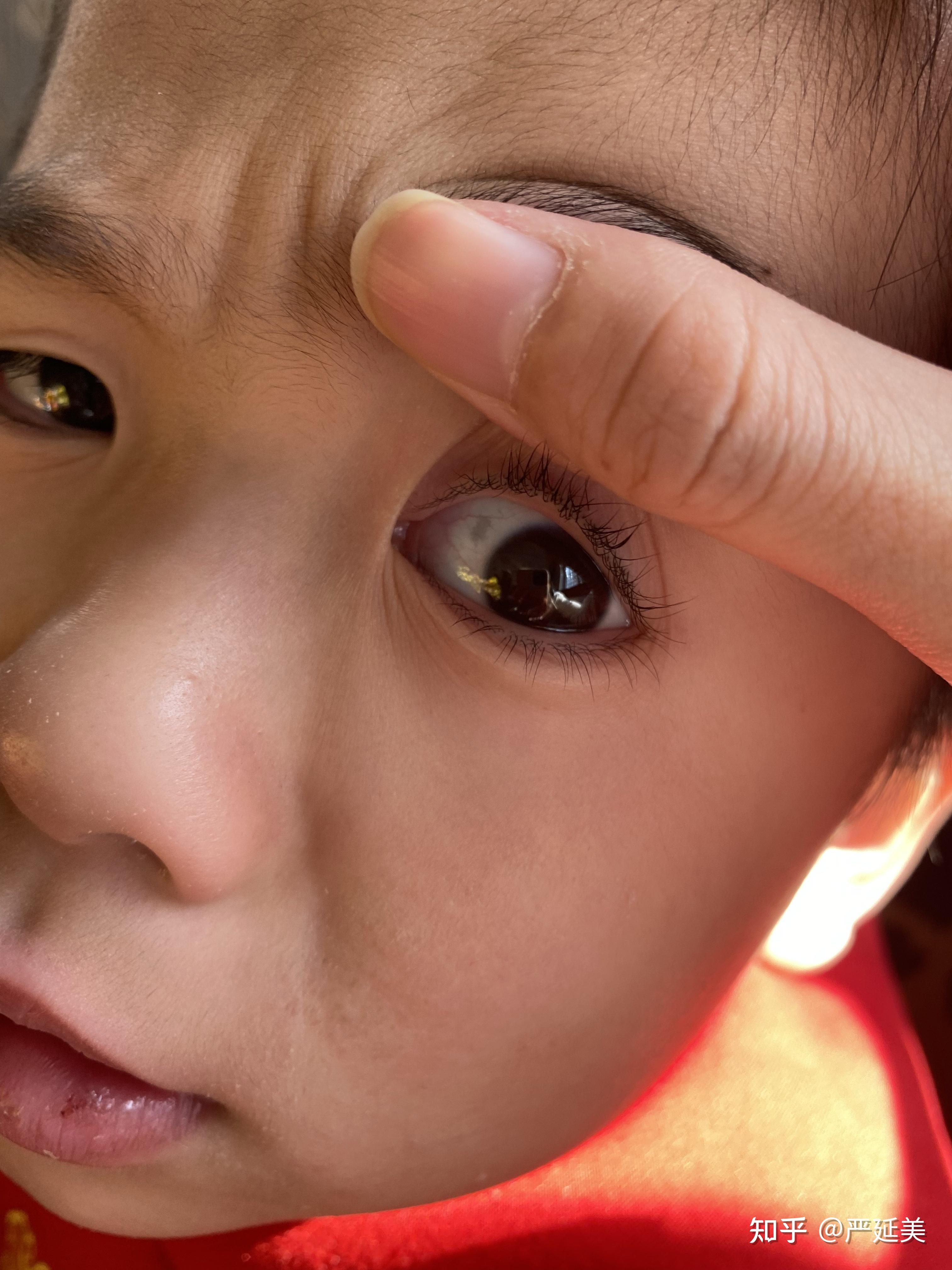 眼睛里有一块灰色的斑点? - 知乎