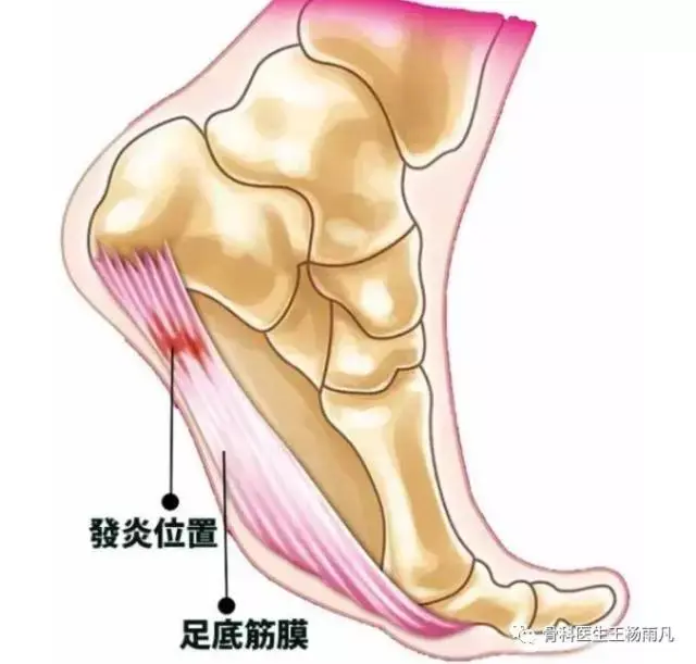 脚踏实地也不易——六问六答，让你彻底了解跟痛症（脚后跟疼痛）！ - 知乎