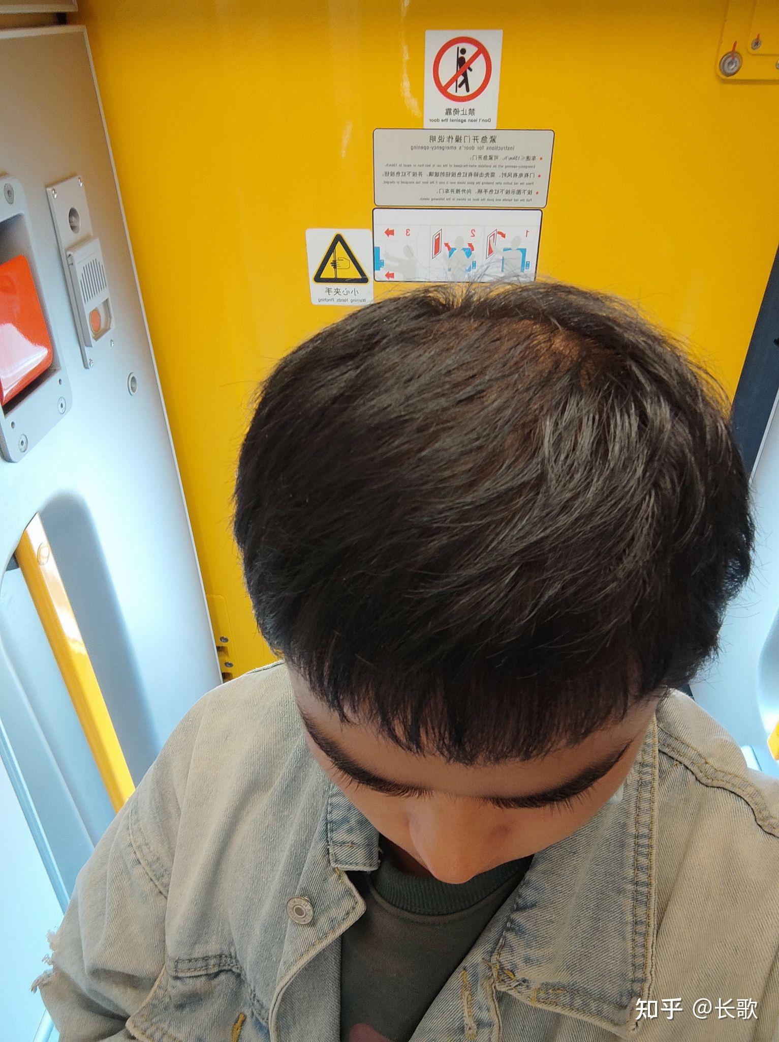 大三的一个男生,21岁,头顶漩涡处头发少得可怜,以前头发很茂密,晚上