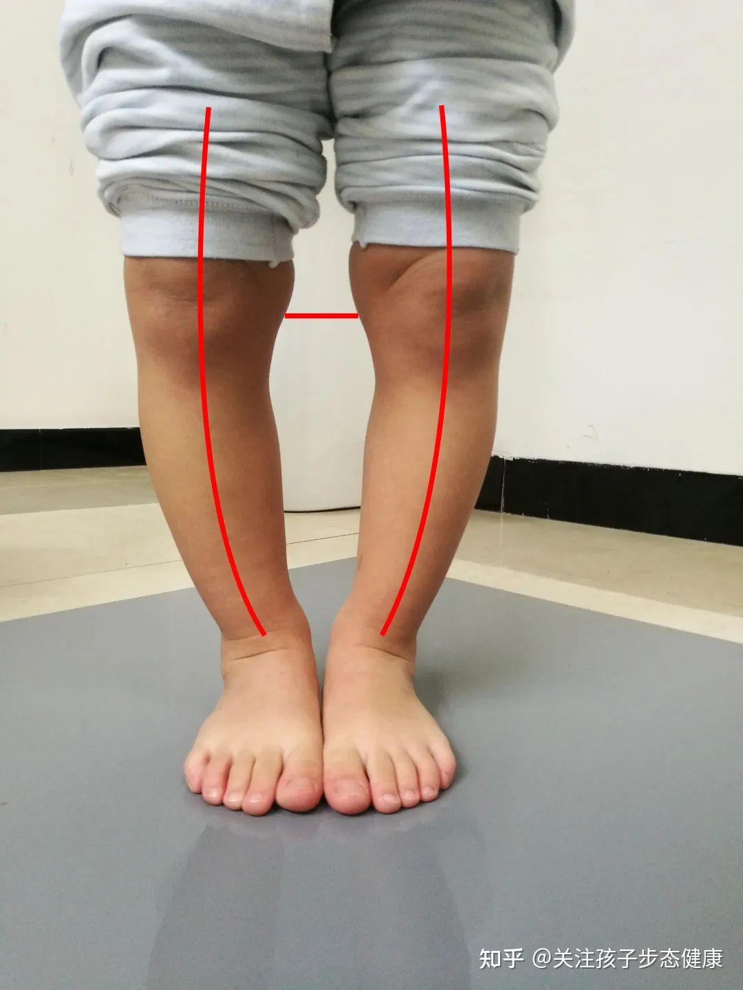 x型腿和o型腿真人图片