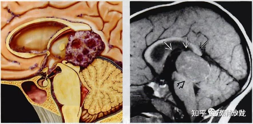 松果體瘤松果體母細胞瘤丨影像診斷要點