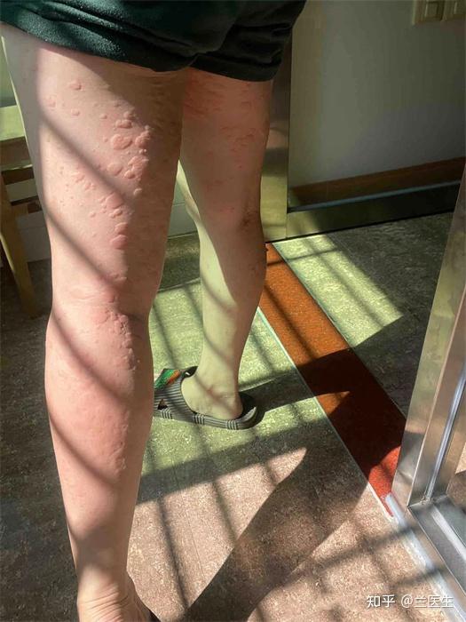 身上突然很痒然后一扣就起一大片红疙瘩还是那种凸起的一大片一大片这