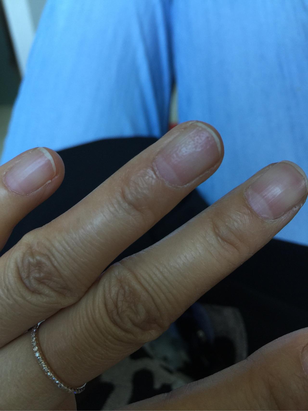 我的指甲上有很多小坑好几年了怎么回事