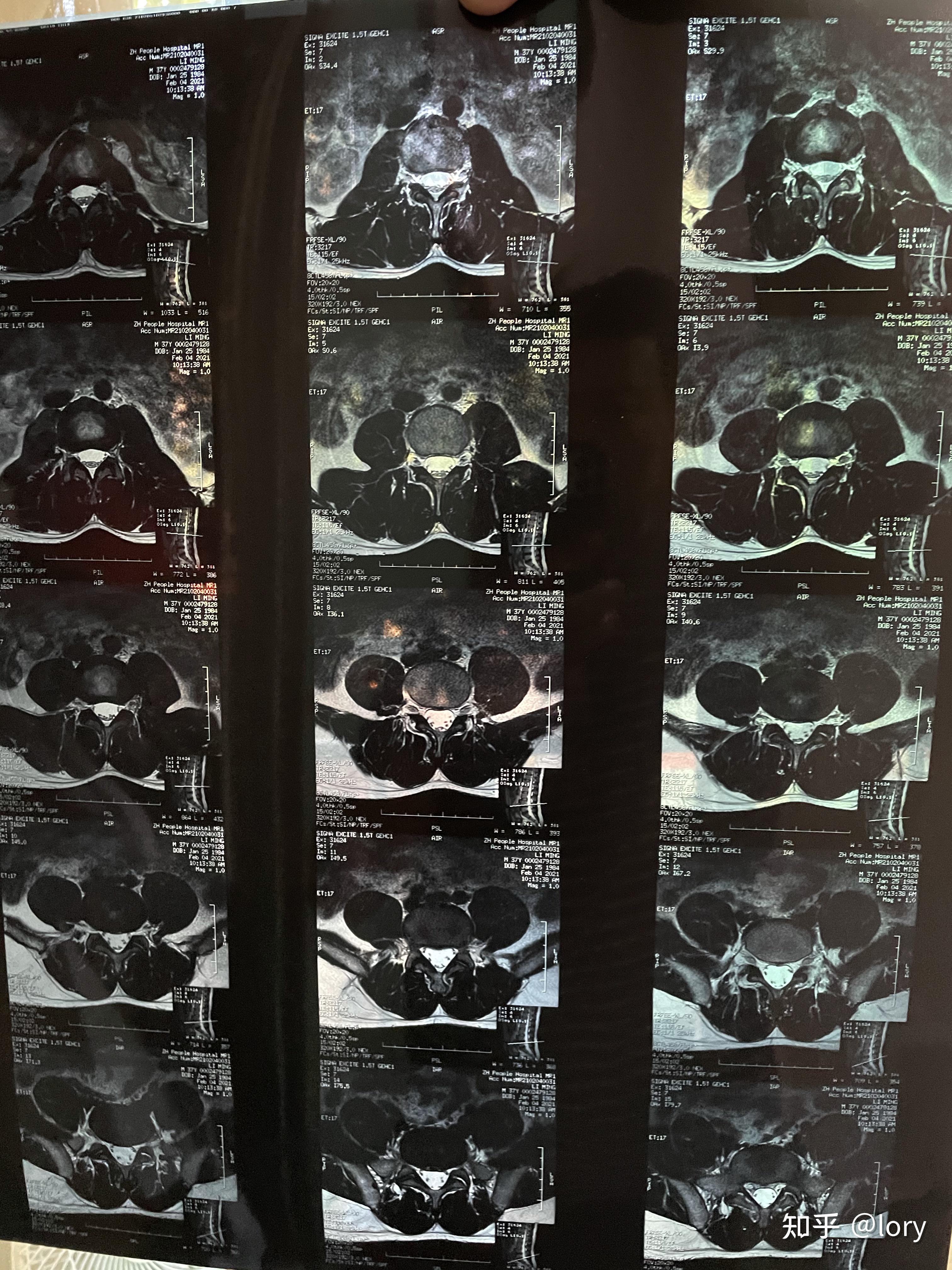 膝盖及腰椎伤病核磁共振结论篮球运动