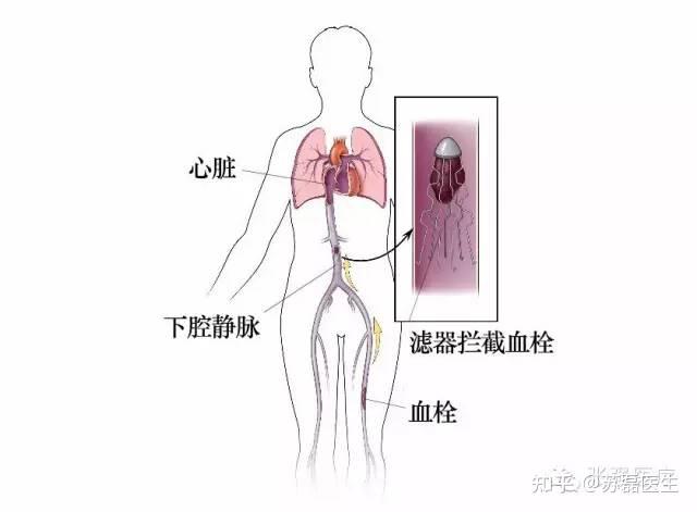 規範和標準下肢深靜脈血栓張強醫療科技