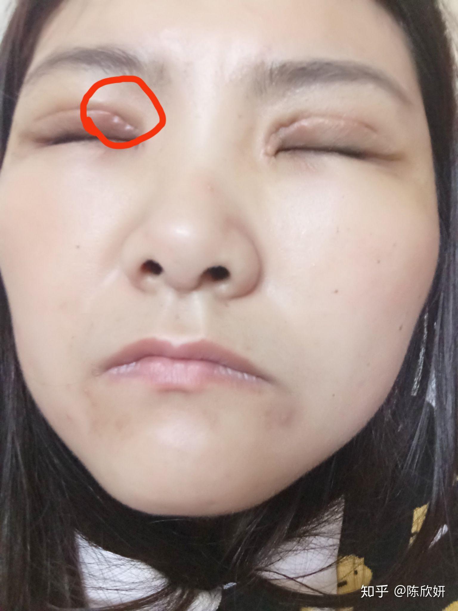 割双眼皮失败是什么样子的